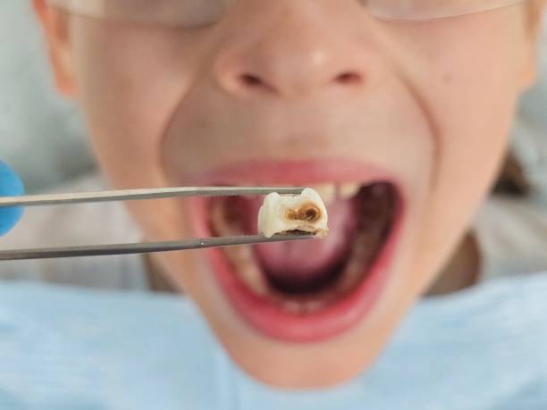 Best Same-Day Emergency Dental Services in Bruce, MS